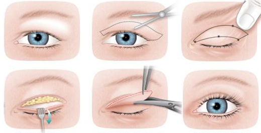 блефаропластика — операция по удалению грыж и избытка кожи в области верхних и нижних век